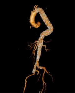 BTEVAR: Branched Thoracic Endovascular Grafts for the Treatment of Thoraco-abdominal Aortic Aneurysms PI: Matthew Sweet Description: An investigator-initiated, prospective, consecutively enrolling, non-randomized single institution clinical evaluation of the safety and effectiveness of branched and fenestrated-branched endovascular stent grafts to preserve branch vessels when used in the treatment of patients with thoraco-abdominal aortic aneurysms. The study evaluates non-FDA-approved off the shelf and custom made branched and fenestrated-branched stent grafts manufactured by Cook Medical.