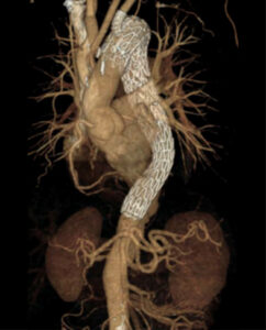 GORE TBE: Thoracic Branch Endoprosthesis PI: Matthew Sweet Description: The objective of this study is to determine whether the GORE® TAG® Thoracic Branch Endoprosthesis is safe and effective in treating lesions of the aortic arch and descending thoracic aorta, requiring Zone 2 proximal implantation of the device.