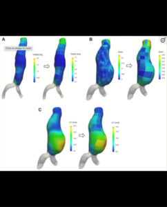 ViTAA PI: Benjamin Starnes Description: This is a Prospective Registry study to collect imaging and clinical data both on patients with aortic aneurysm disease undergoing serial monitoring and on patients pre and post-endovascular repair, using ViTAA (The Sponsor) aortic mapping technology.